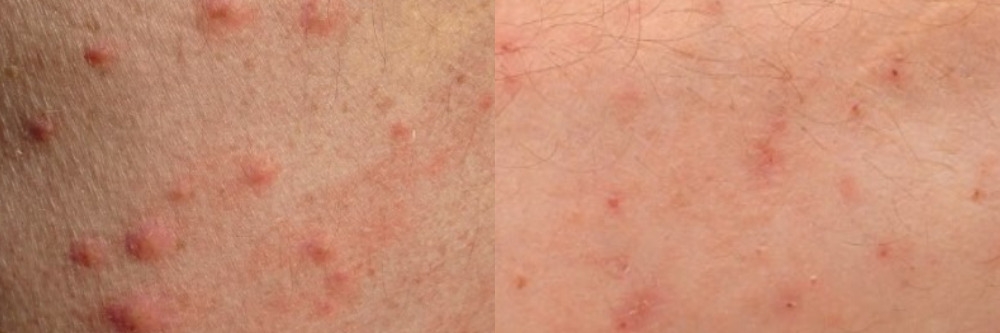 Bed Bug and Dust Mite Bite
